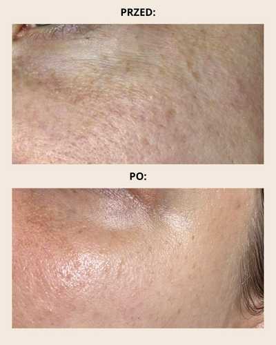 Radiofrekwencja mikroigłowa Poznań